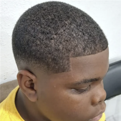 Scalp Treatment